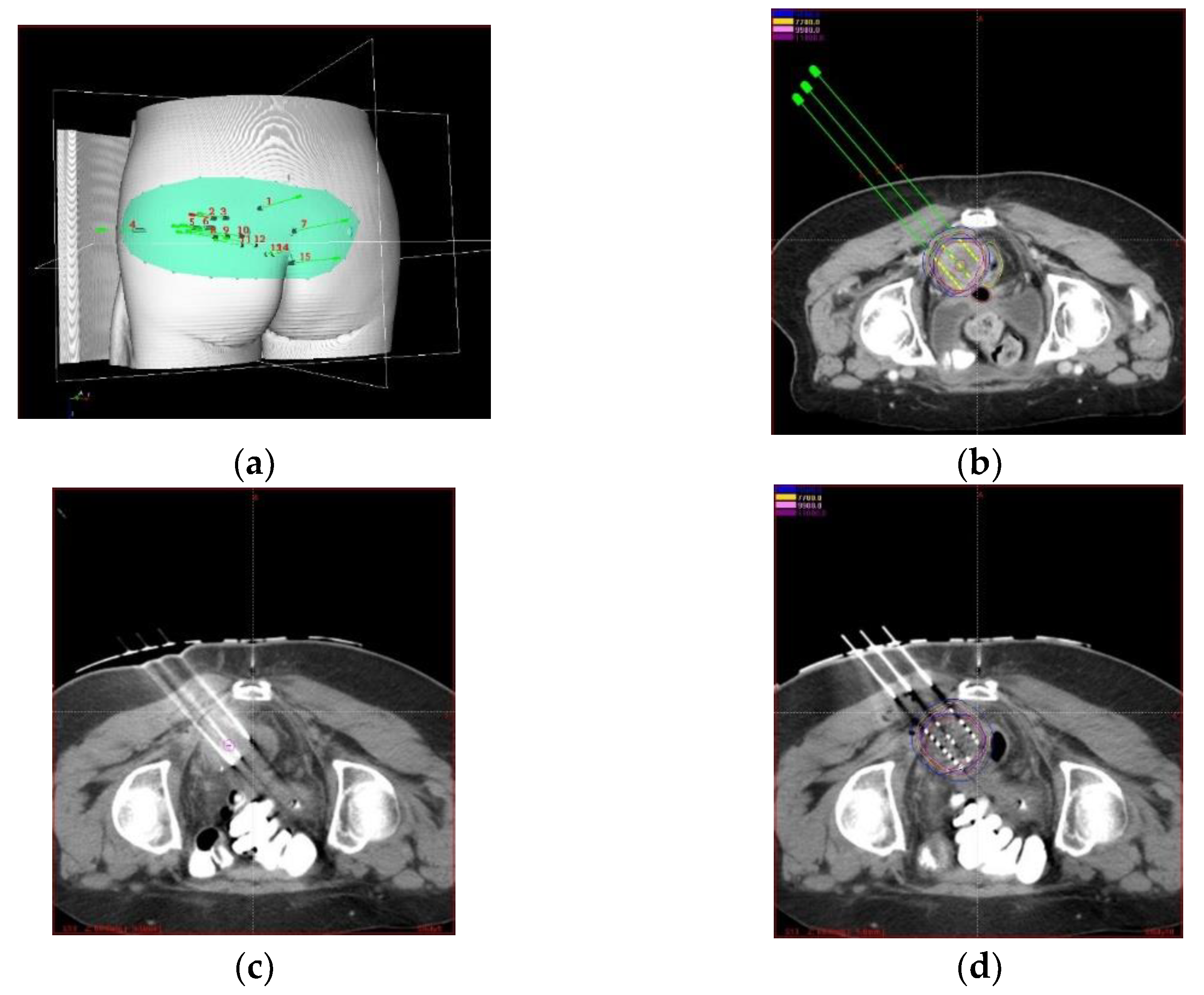 beriwal re-irradiation endometrial cancer