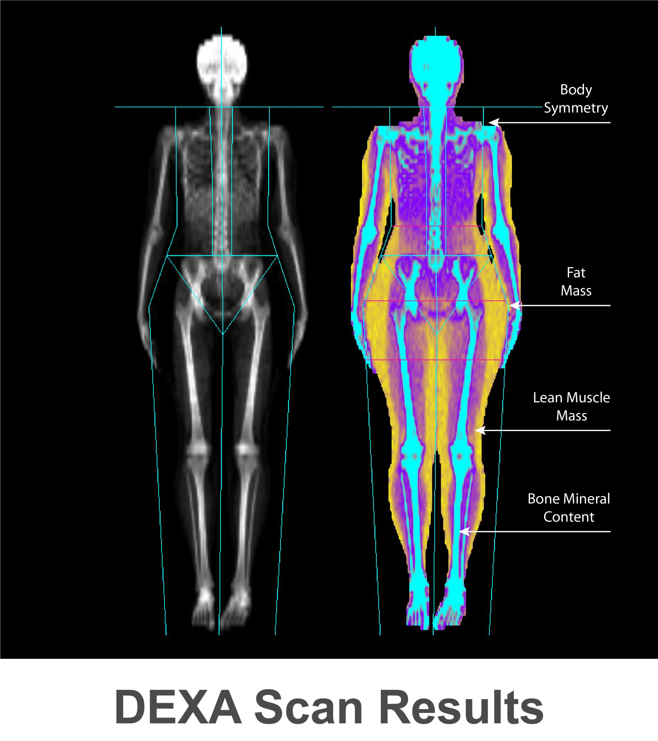 Accurate Body Fat Testing: Try a Gemini DEXA Scan Today